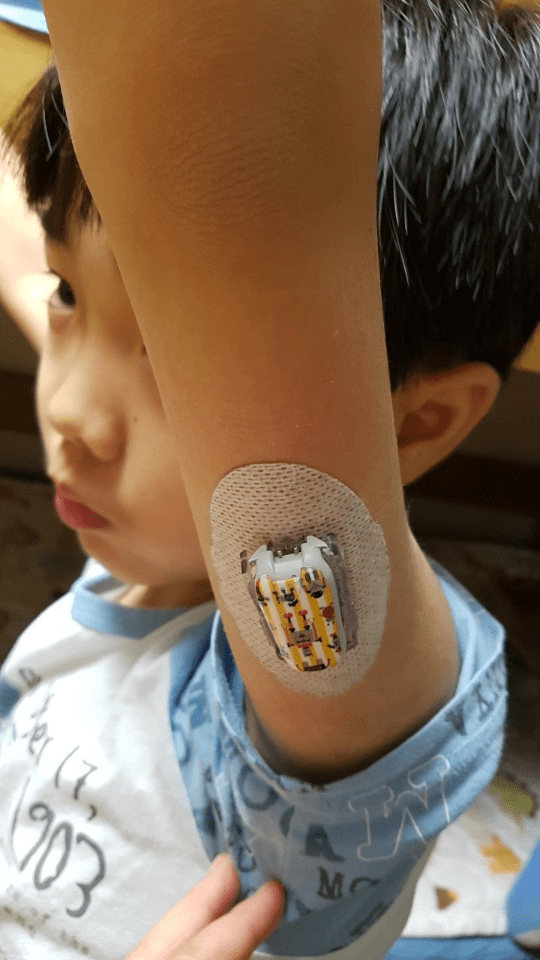 SonWithDexcomInArm